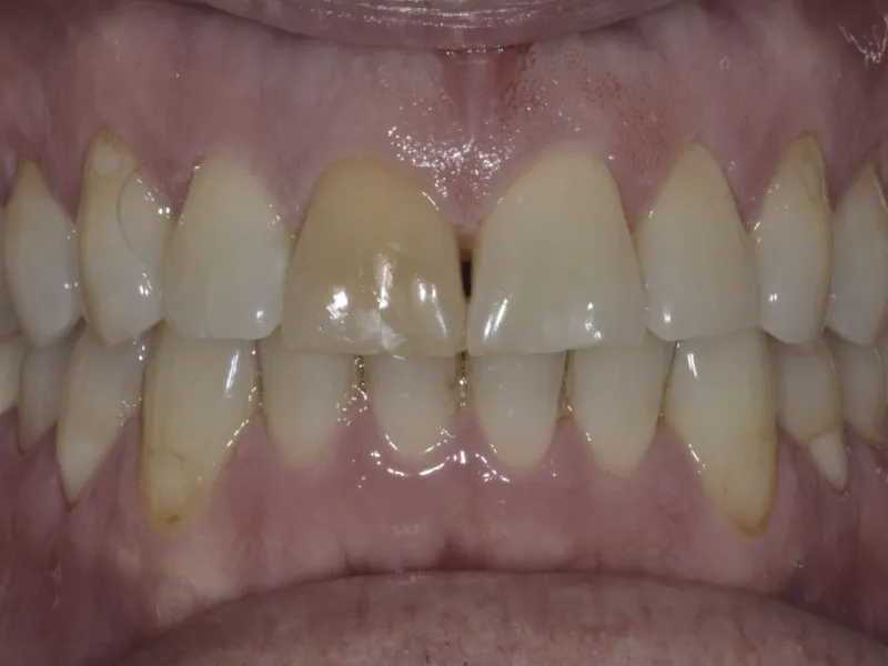 case 505 retracted before photo