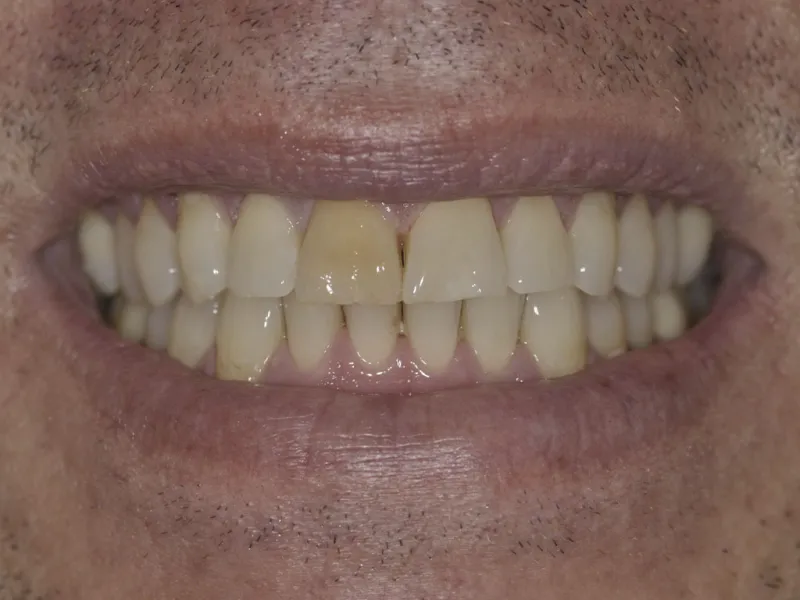 Case 505 Smile Before Photo
