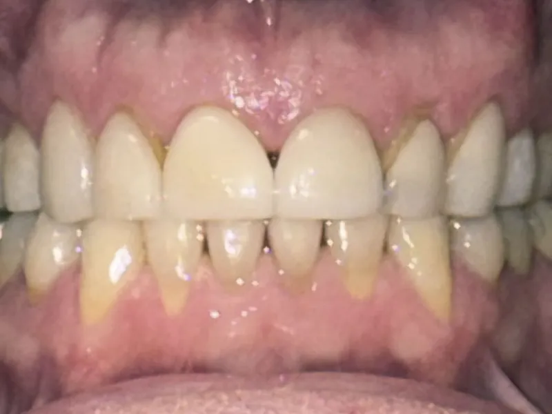 case 506 retracted before photo