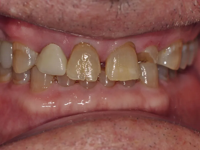case 507 retracted before photo