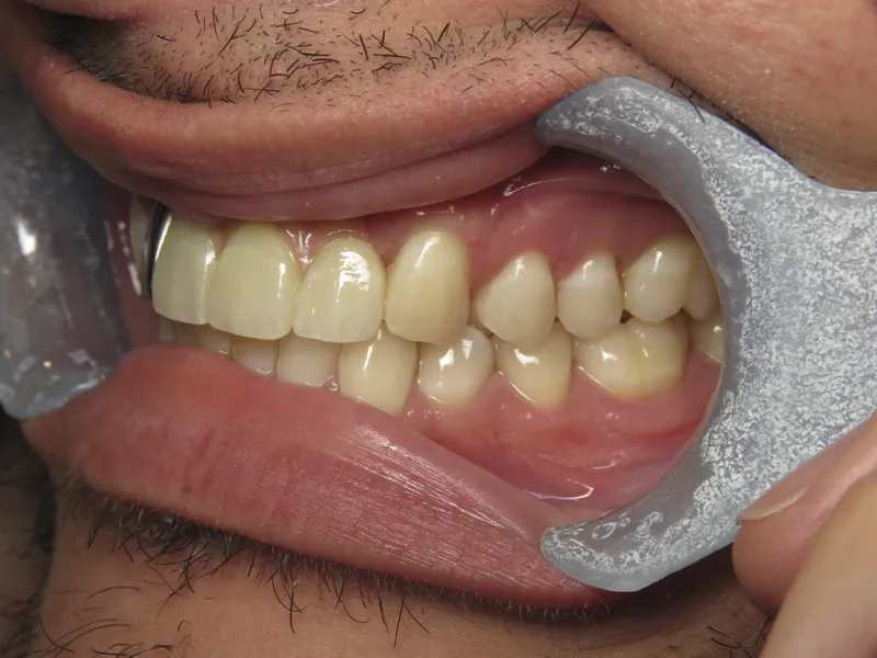 Case 601 Side After photo