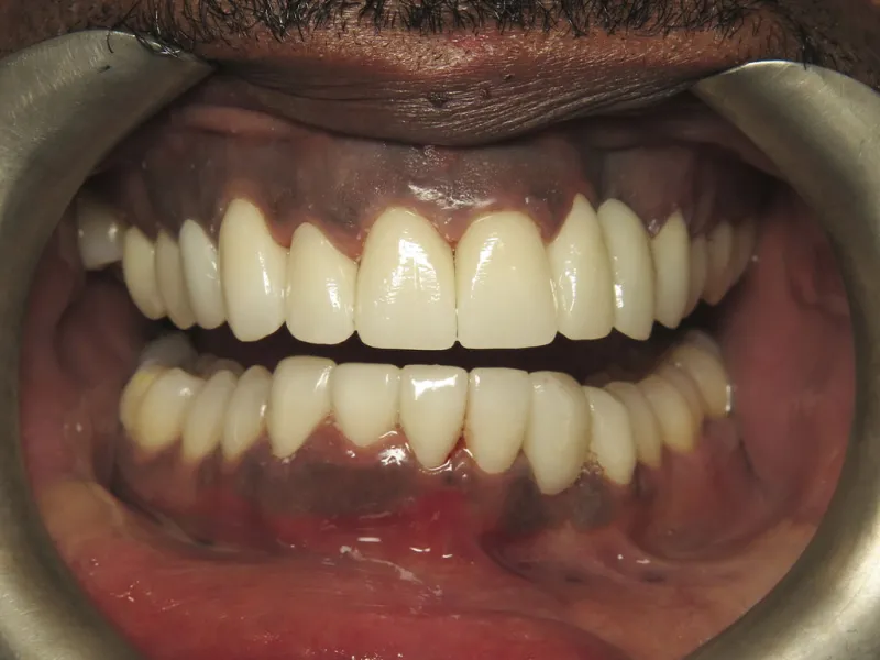 picture of case 603 retracted after smile