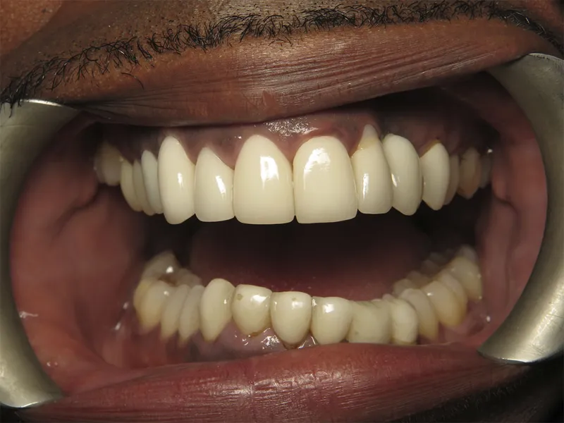 picture of case 603 retracted before smile