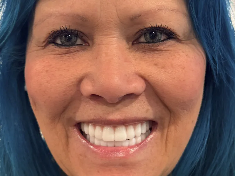 A full face smiling photo post replacement.