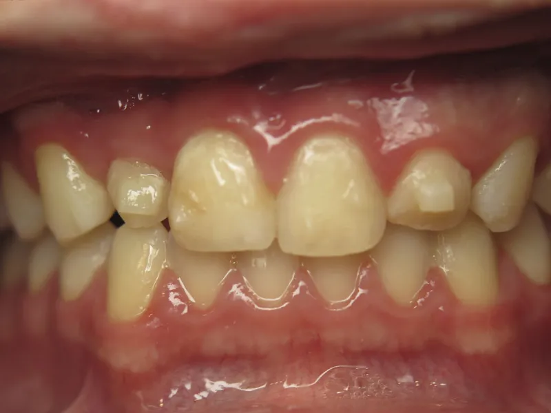 case 606 retracted before photo