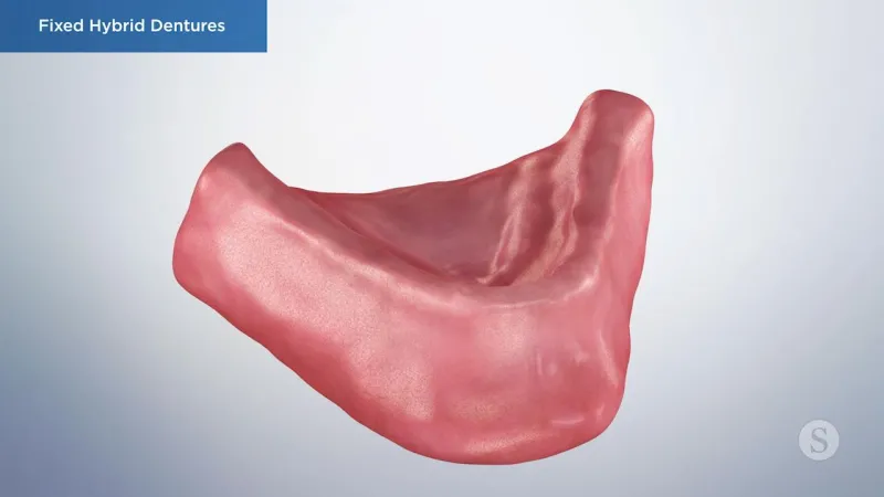 A video still - Fixed Hybrid Dentures with an image showing bottom gum to have dentures be placed on it.