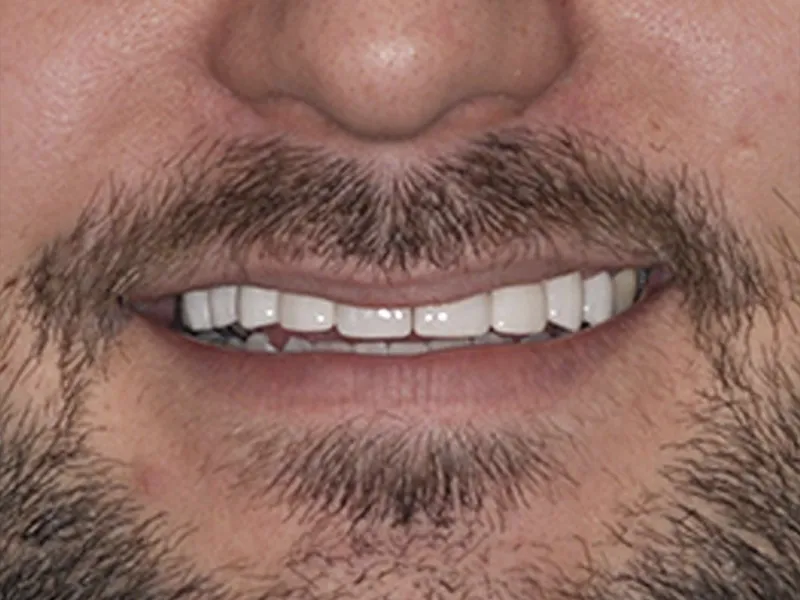 fixing missing and misaligned teeth photo