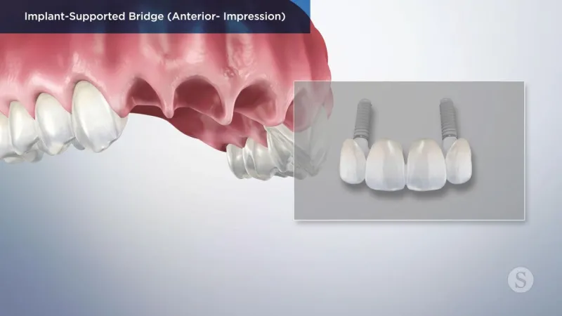 A video still - Implant-Supported Bridge (Anterior - Impression) with an image showing the top row of teeth with the front missing and an image box with the replacement supported bridges.