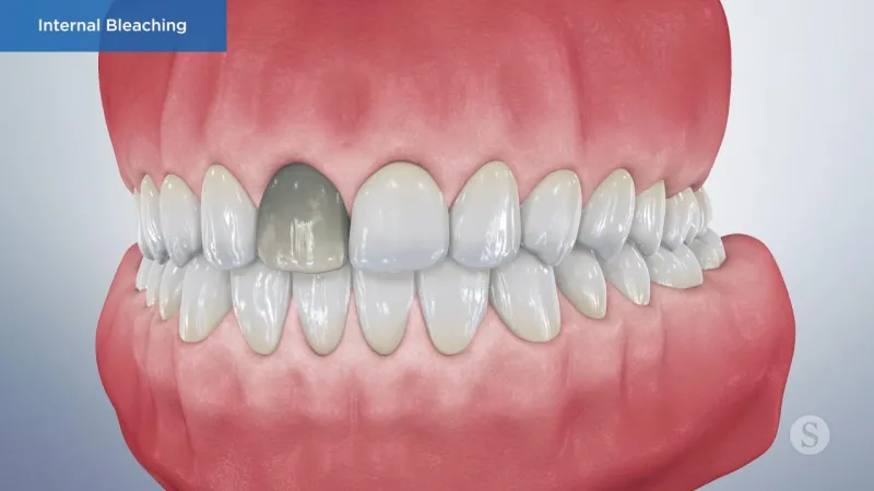 A video still - Internal Bleaching with an image showing a set of teeth with the front top tooth on the left that is gray.