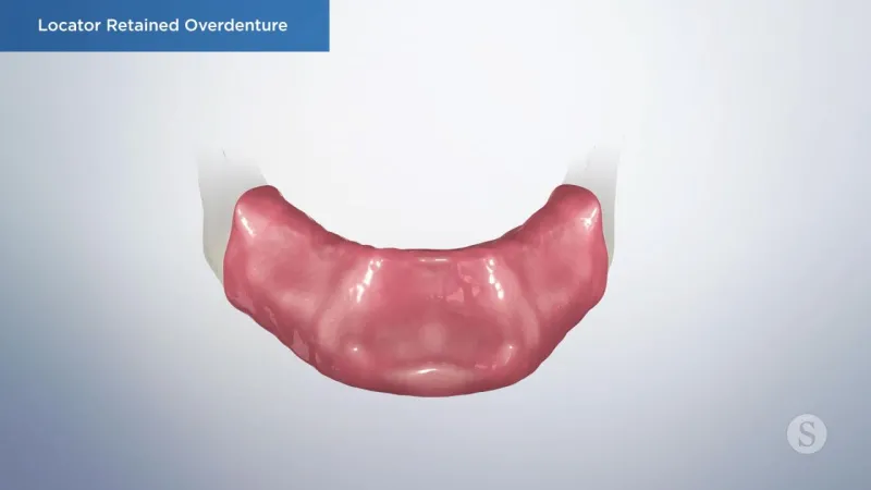 A video still - Locator Retained Overdenture with a image showing bottom mouth of the gums where the over denture will be placed.