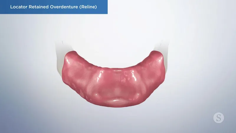 A video still - Locator Retained Overdenture (Reline) showing an image of the bottom gums.