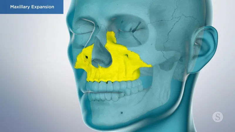 A video still - Maxillary Expansion with an image showing a side view of the skull and jaw with the upper jaw highlighted.