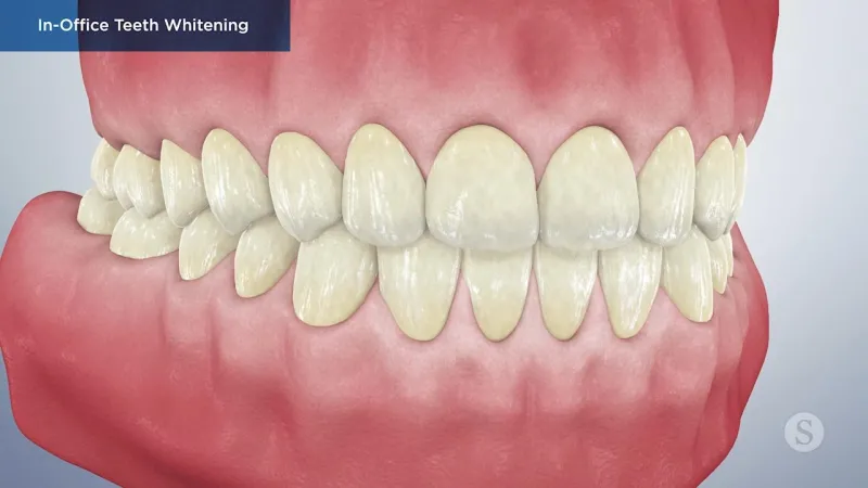 A video still - In-Office Teeth Whitening with an image showing a set of teeth and gums.