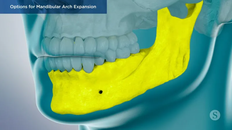 A video still - Options for Mandibular Arch Expansion with an image showing the lower jaw highlighted.