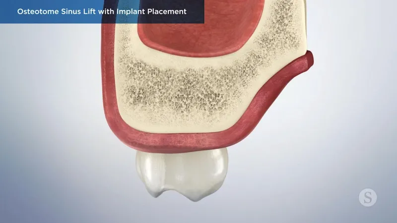 A video still - Osteotome Sinus Lift with Implant Placement with an image showing a close up of a tooth, gum and bone.