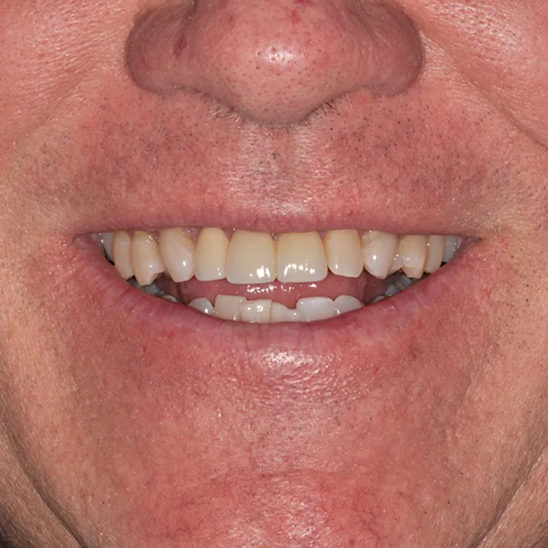after Repairing Teeth That Are Stained with Receding Gums