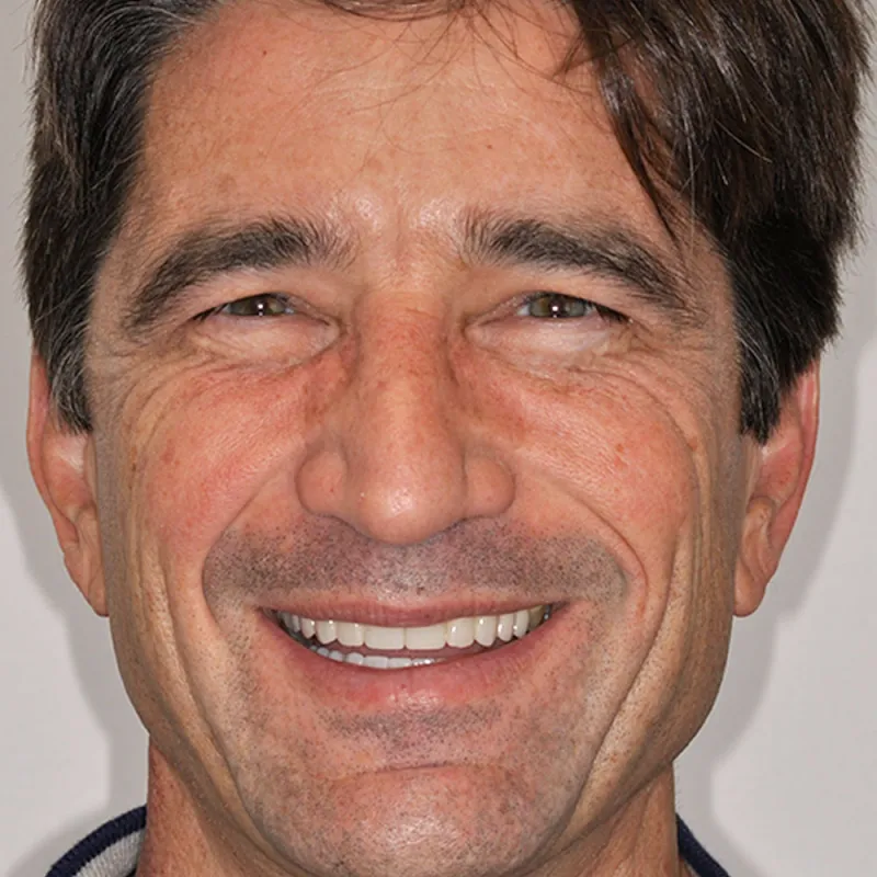 After Giving a Patients Smile a More Youthful Look