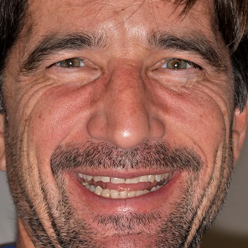Before Giving a Patients Smile a More Youthful Look