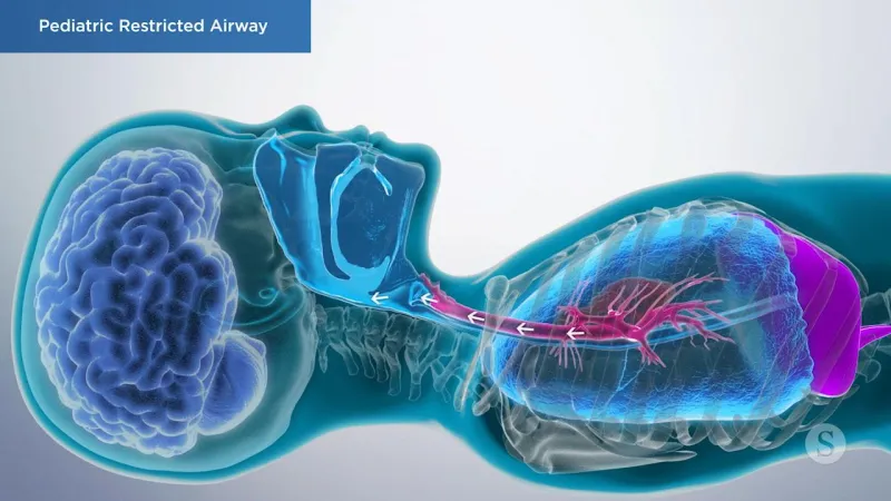 A video still - Pediatric Restricted Airway with an image showing a child laying down and the airflow and organs.