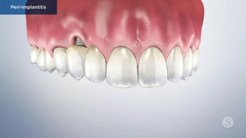 A video still - Peri-Implantitis with an image showing the top teeth and gums with a hole between one tooth and gumline.