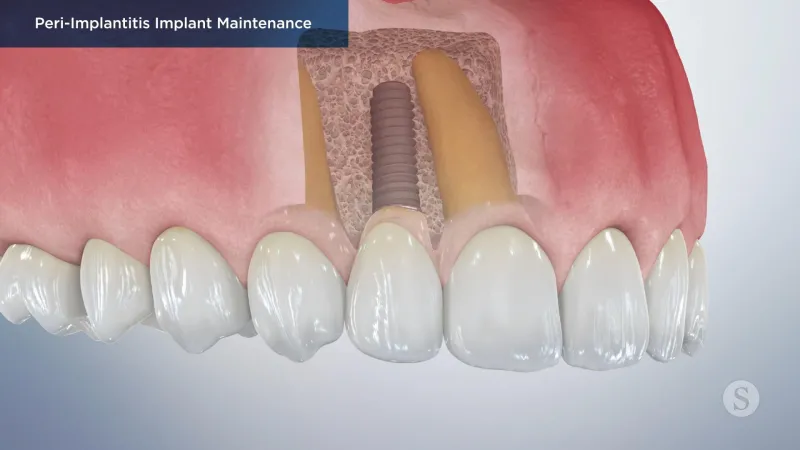 A video still - Peri-Implantitis Implant Maintenance with an image showing a close up of the top teeth and gum with the implant and root in the gums.