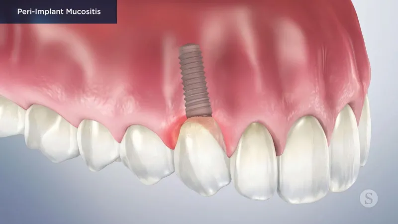 A video still - Peri Implant Mucositis with an image showing the top teeth and gum with a implant.