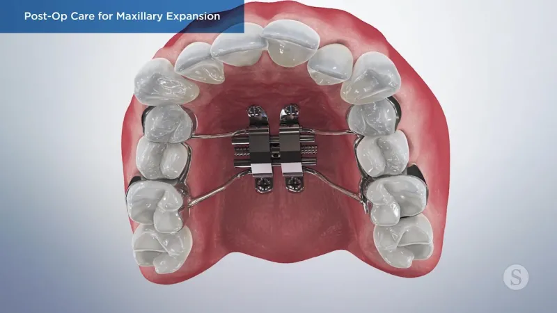 A video still - Post-Op Care for Maxillary Expansion with an image showing a close up of the top of the mouth with a maxillary expansion in.