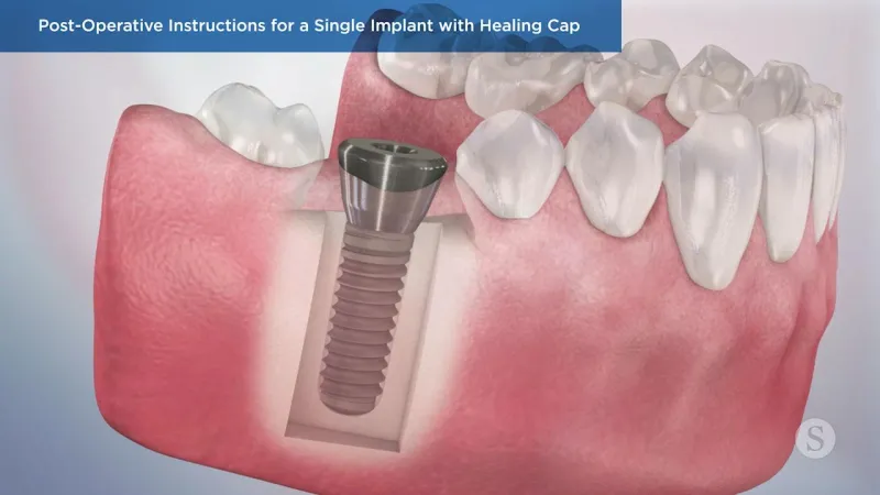 A video still - Post-Operative Instructions for a Single Implant with Healing Cap with an image showing an implant in the gum.
