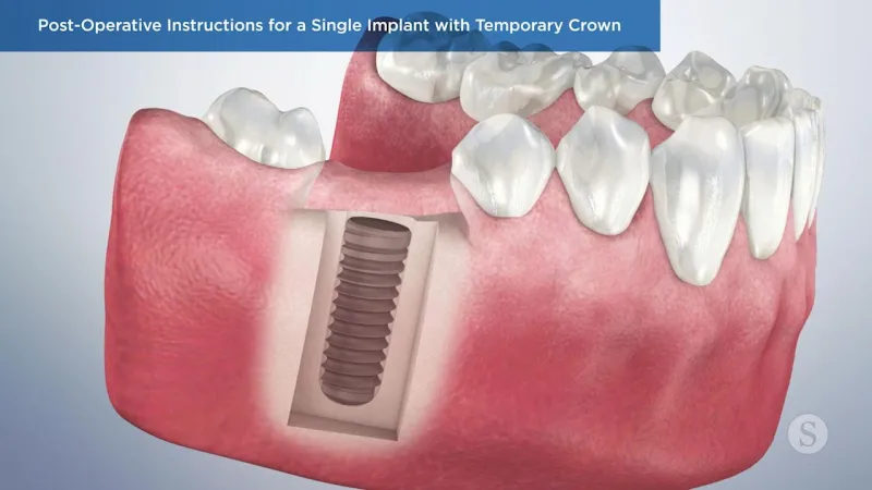 A video still - Post-Operative Instructions for a Single Implant with Temporary Crown with an image showing an implant placed in the gums.