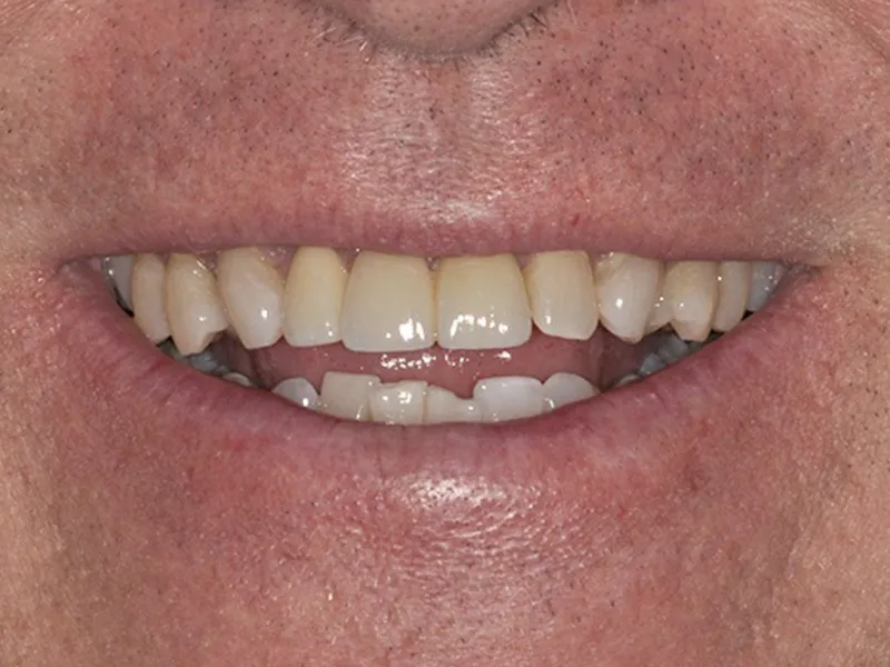 repairing teeth that are stained with receding gums