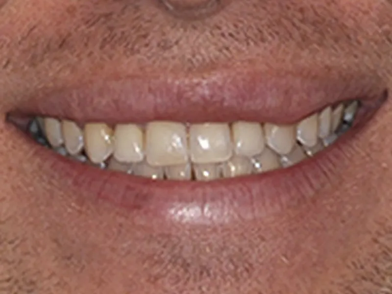 repairing two teeth and improving the whole smile photo