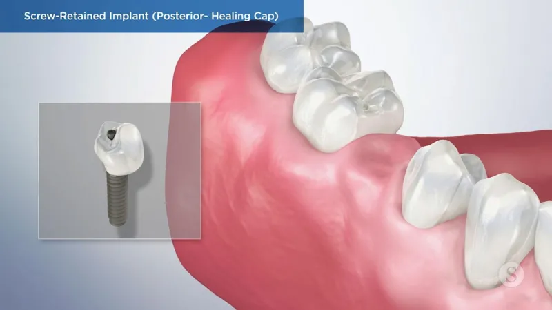 A video still - Screw-Retained Implant (Posterior- Healing Cap) with an image showing an implant next to a set a teeth with a missing tooth.