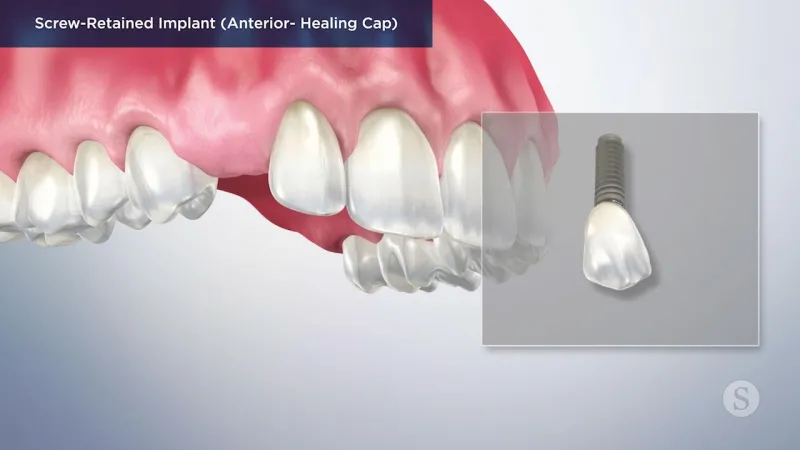 A video still - Screw Retained Implant (Anterior- Healing Cap) with an image showing the top row of teeth with a gap for an implant to be placed.