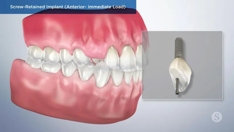 A video still - Screw Retained Implant (Anterior- Immediate Load) with an 3d image of the teeth and gums with a missing tooth where an implant to go.