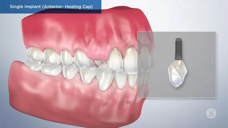 A video still - Single Implant (Anterior- Healing Cap) with an image showing the gums and teeth with a close up of the single implant.