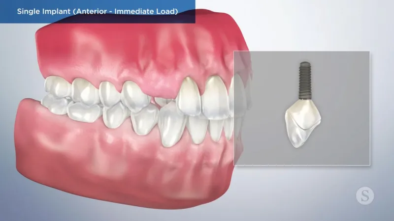 A video still - Single Implant (Anterior- Immediate Load) showing an image with teeth and gums with a single implant next to them.