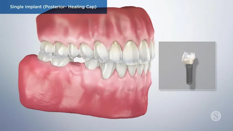 A video still - Single Implant (Posterior- Healing Cap) showing an image of teeth and gums with a single implant next to it that will be inserted.