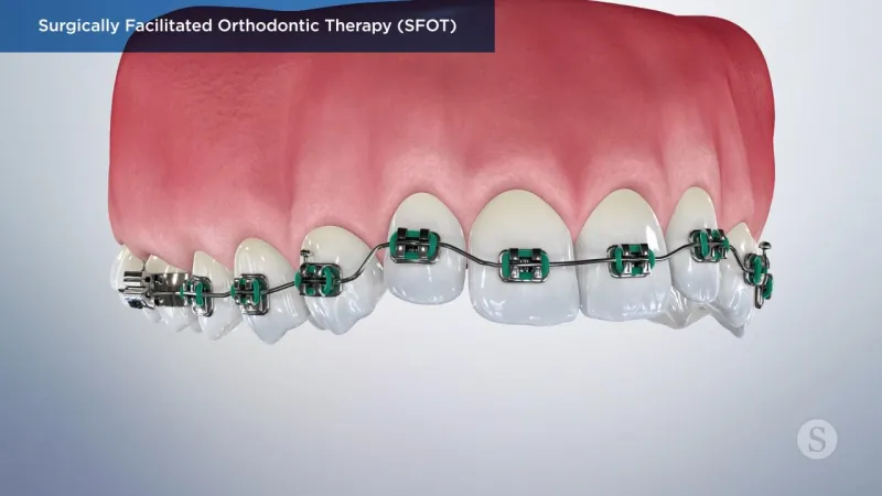 A video still - Surgically Facilitated Orthodontic Therapy showing an image of the top teeth with braces on them.