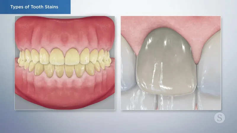 A video still - Types of Tooth Stains with an image showing yellow teeth and an unclose tooth that appears to have turned gray.