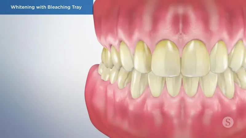 A video still - Whitening with Bleaching Tray with an image showing teeth that are yellow.